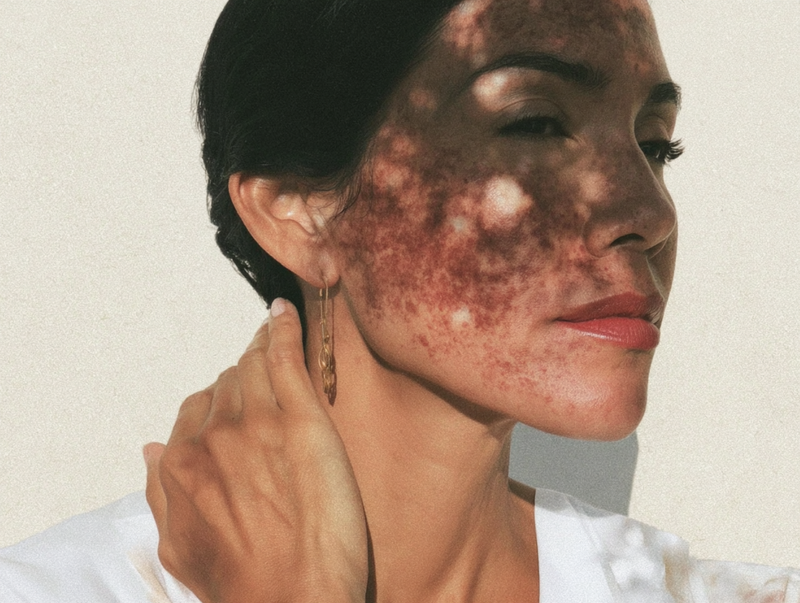 Types of Hyperpigmentation: Dark Spots, Melasma, and How Sun Protection Fits